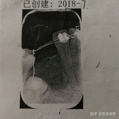 疫情期间正畸，疫情期间正畸有必要吗-第1张图片