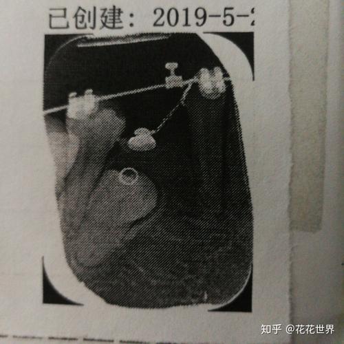 疫情期间正畸，疫情期间正畸有必要吗-第2张图片