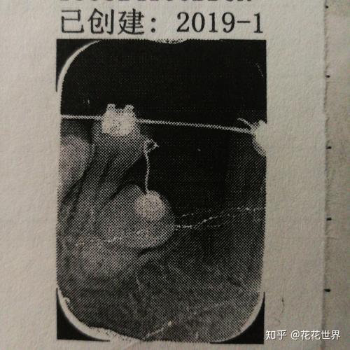 疫情期间正畸，疫情期间正畸有必要吗-第10张图片