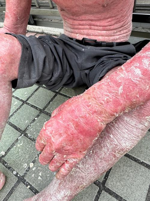 为什么一出行下肢就水肿-为什么一出门走路腿就痒-第6张图片 为什么一出行下肢就水肿-为什么一出门走路腿就痒-第6张图片