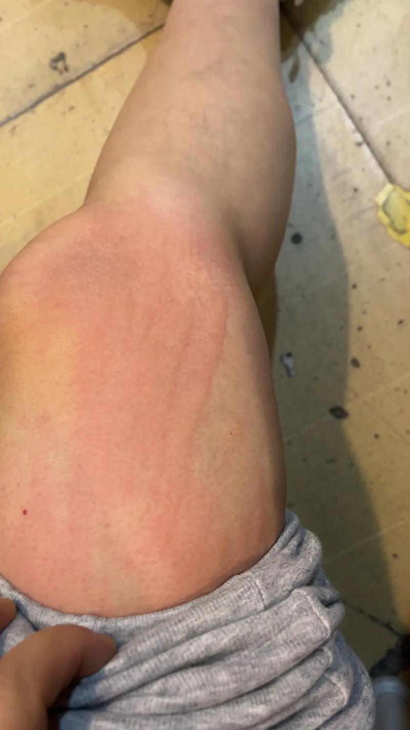 哪种天气适合过敏者出行，过敏性体质哪个季节容易过敏?-第6张图片