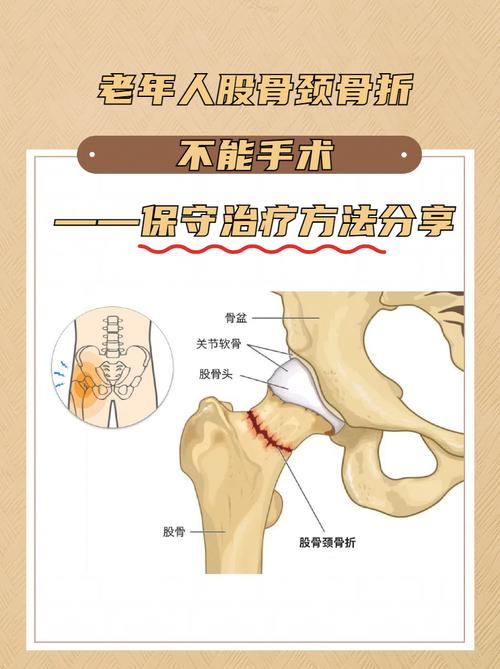 股骨骨折怎么出行，股骨骨折处理-第1张图片
