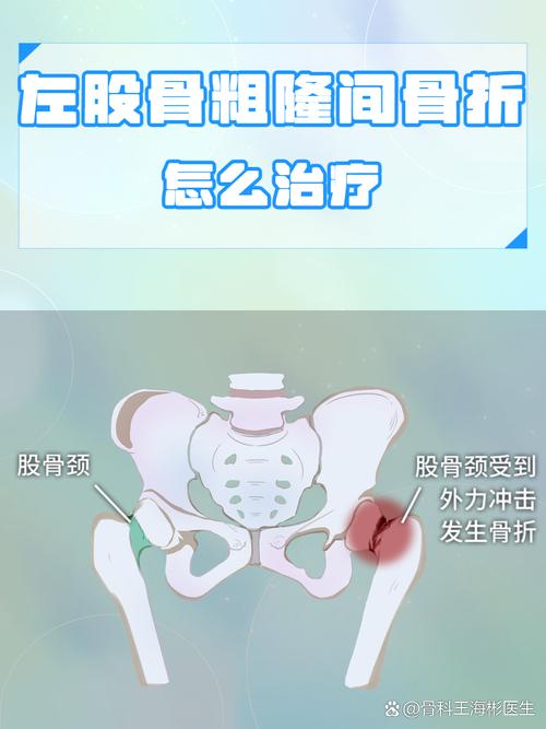 股骨骨折怎么出行，股骨骨折处理-第4张图片