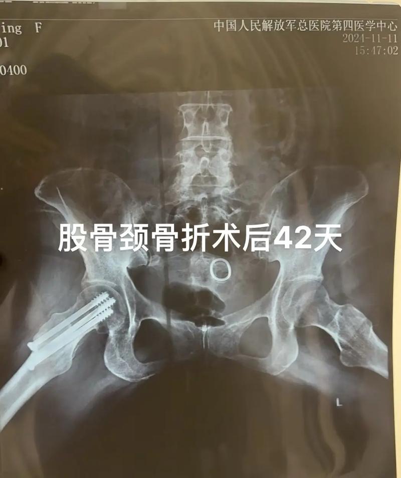 股骨骨折怎么出行，股骨骨折处理-第6张图片