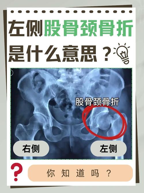 股骨骨折怎么出行，股骨骨折处理-第7张图片